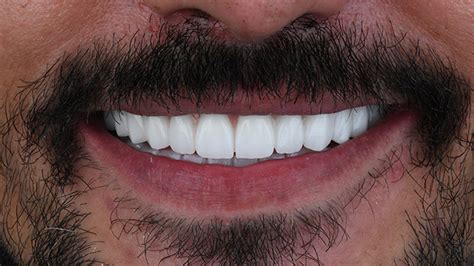 reddit turkey|best veneers in turkey reddit.